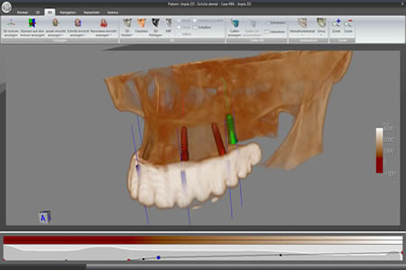 Impla-3D Zahn Software